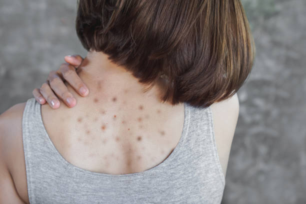 How to get rid of the pimples on your back once and for all - MangoFeeds